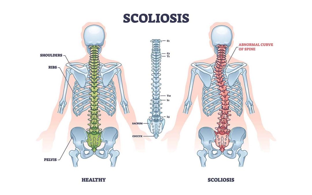 Scoliosis